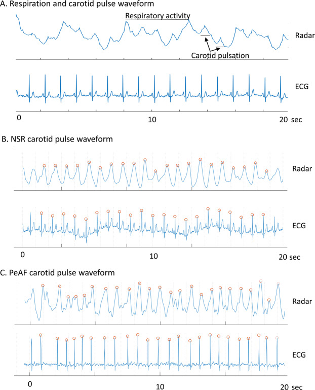Breathing and pulse in one radar signal
